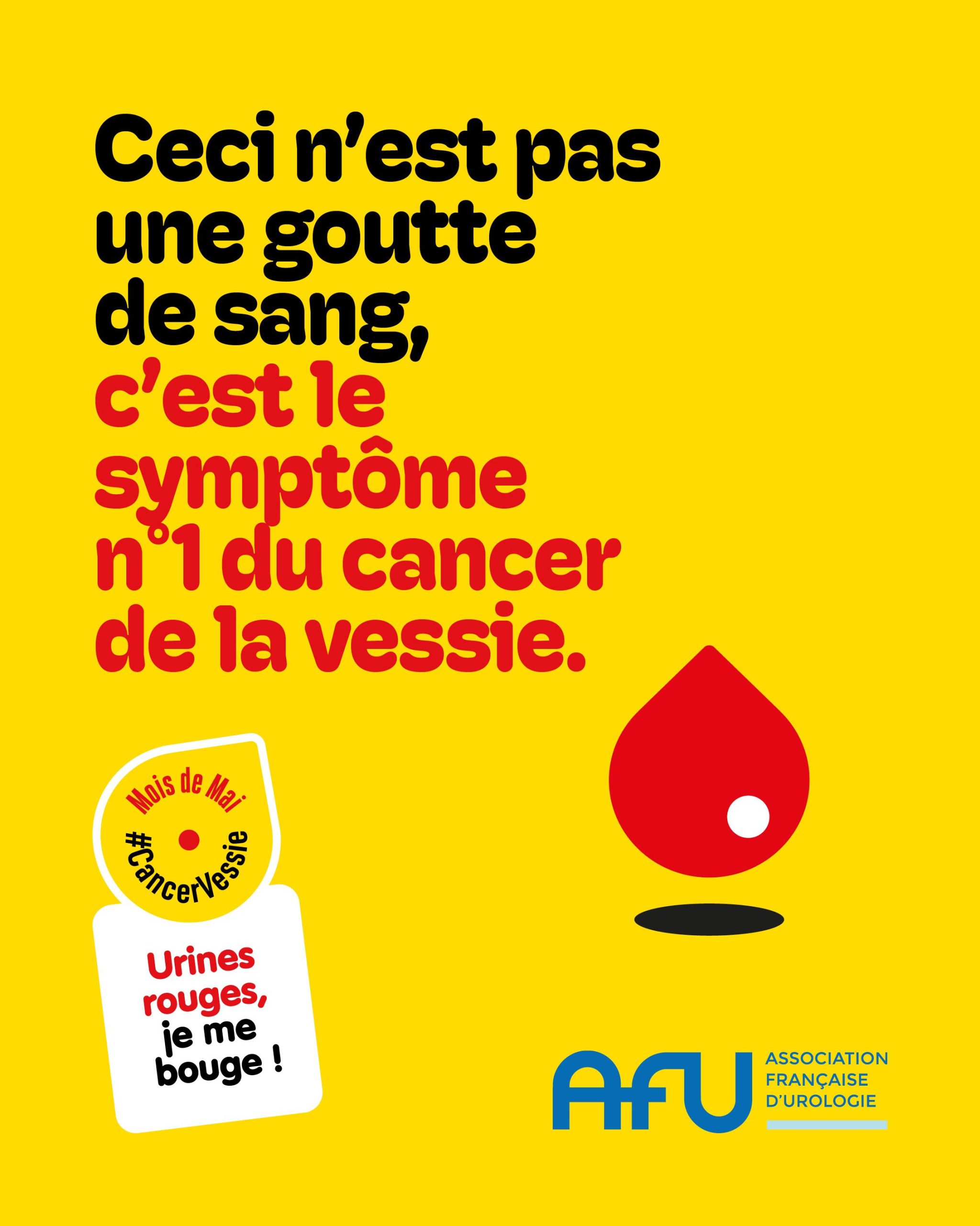 AFU cancer vessie 2025 - 1080x1350 goutte-compressed